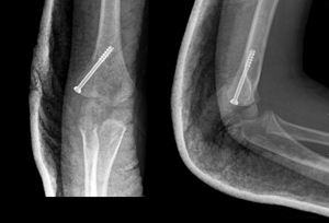 Figure 4C_0953789 Lateral condyle delayed union 3.jpg